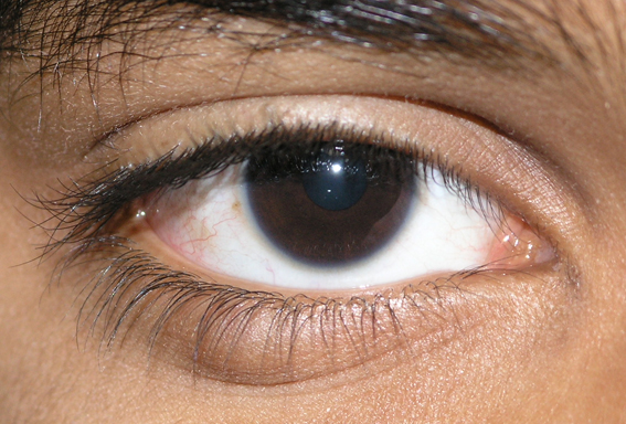 Liverpool Eye Clinic - Eyelid Cysts