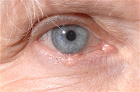 basal cell carcinoma eyelid